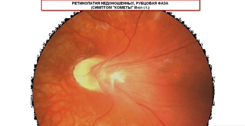 ретинопатия